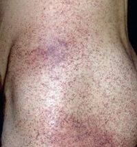 angiokeratoma 6 e1678460691135